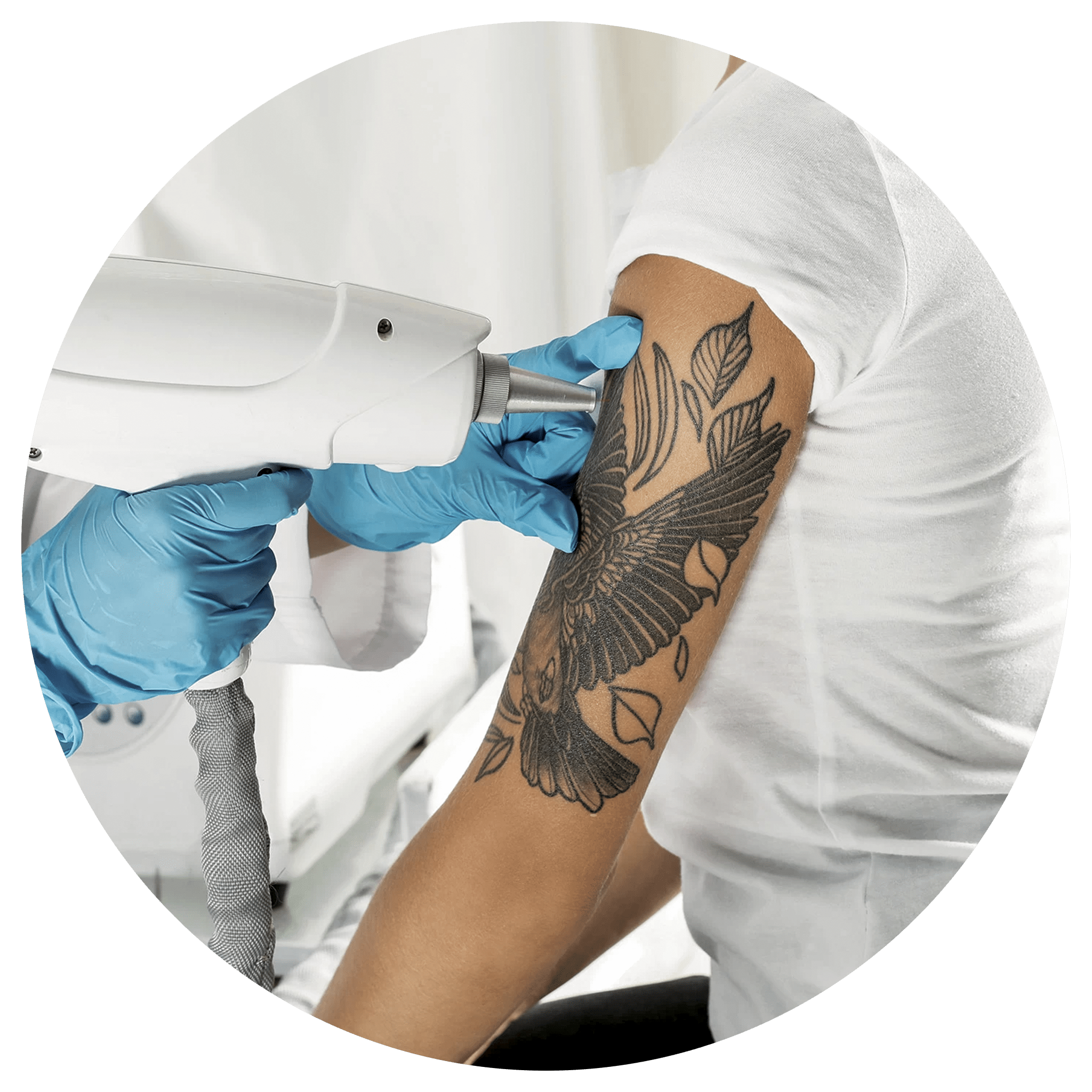 tatoo removal