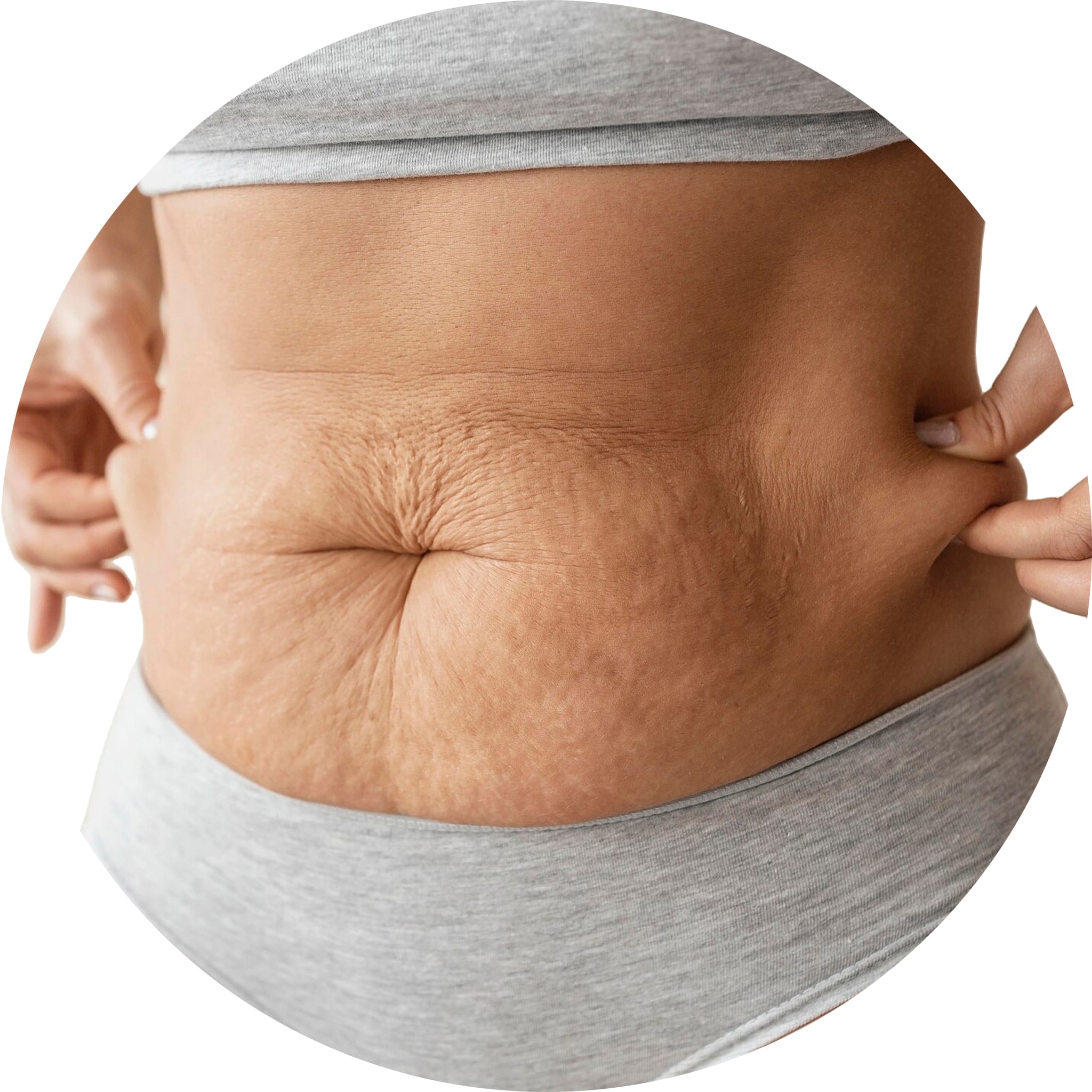 stretch marks treatment treatment in Hyderabad stretch marks treatment treatment in Hyderabad