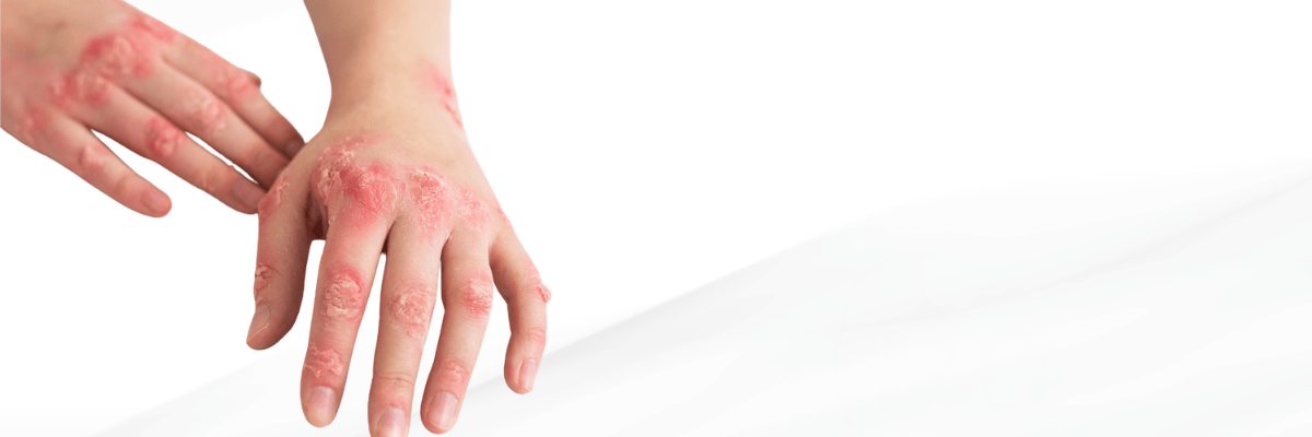 psoriasis treatment in Hyderabad