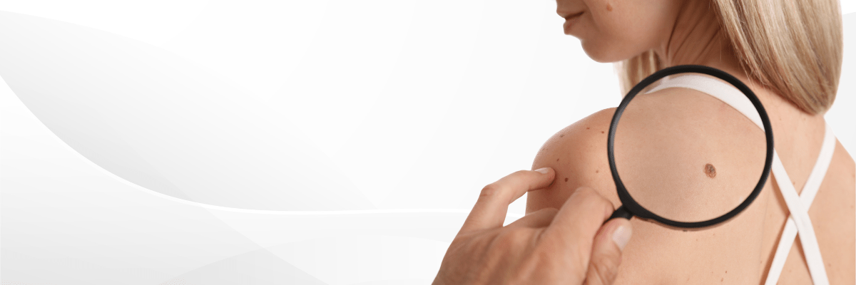 skin tags removal treatment in Hyderabad 