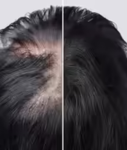 best hair fall treatment in Hyderabad